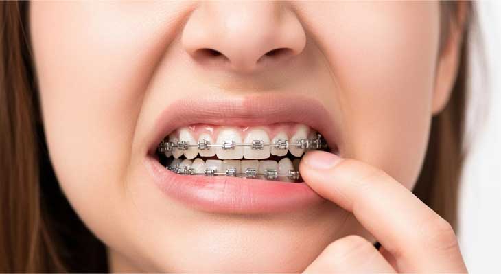 لق شدن دندان در ارتودنسی