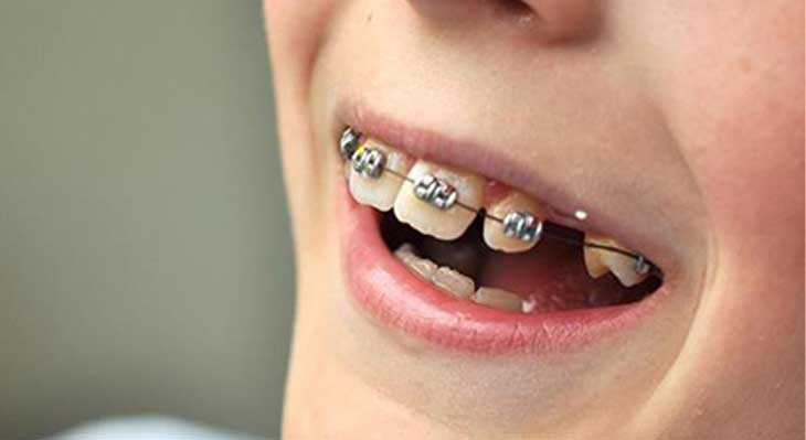 ارتودنسی دندان های جلو