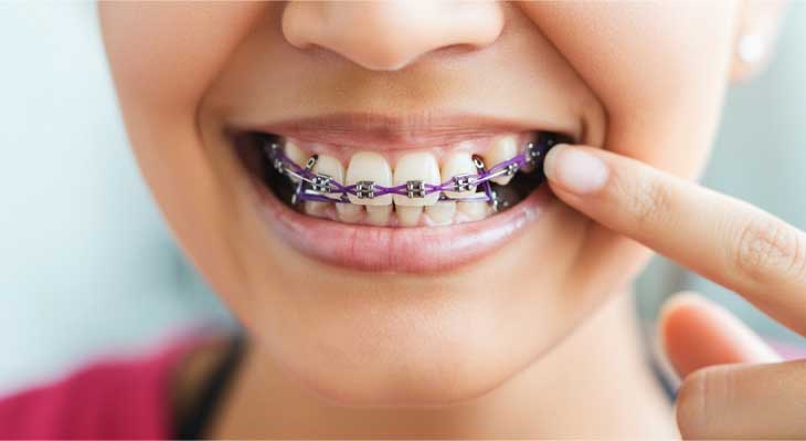 لق شدن دندان در ارتودنسی