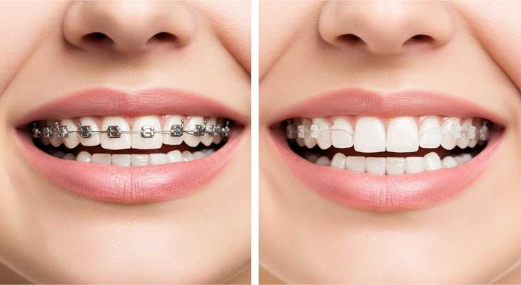 ارتودنسی یک فک