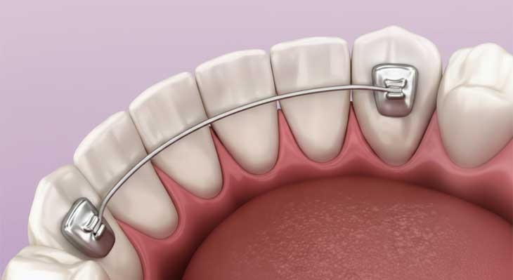 سیم پشت دندان ارتودنسی