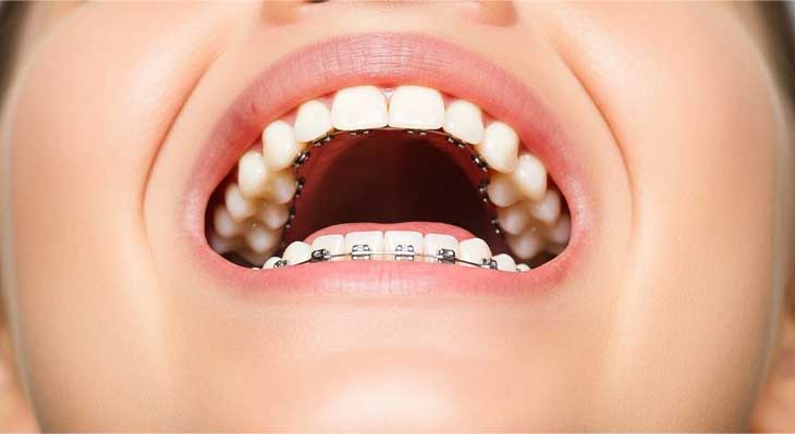 ارتودنسی لینگوال چیست؟