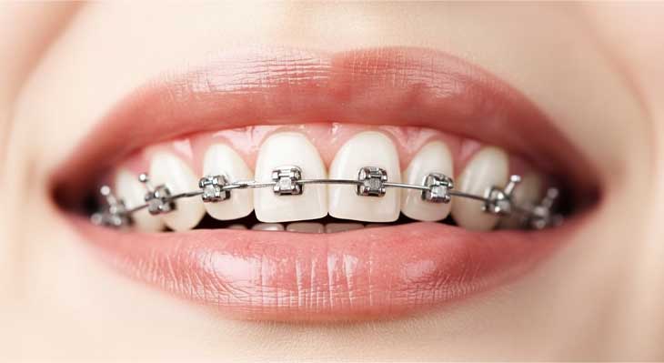 ارتودنسی یک فک