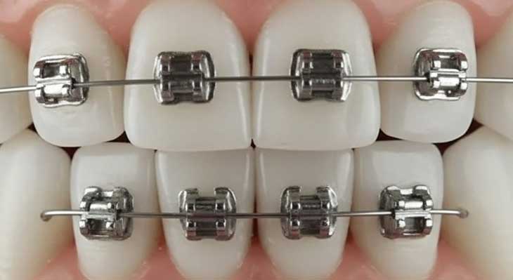 ارتودنسی چند دندان