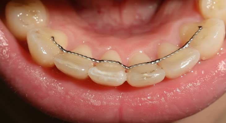 سیم پشت دندان ارتودنسی
