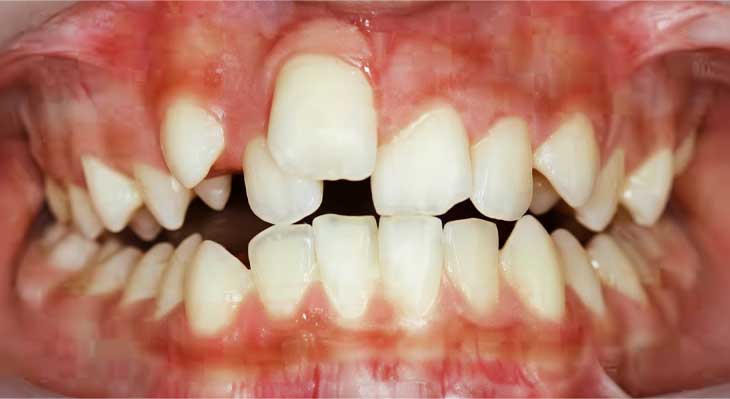 دندان های نامرتب