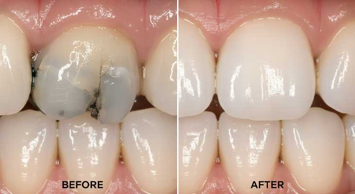 ترک خوردگی و شکستگی دندان