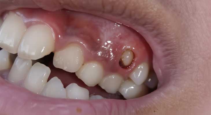 در آمدن دندان بالای لثه