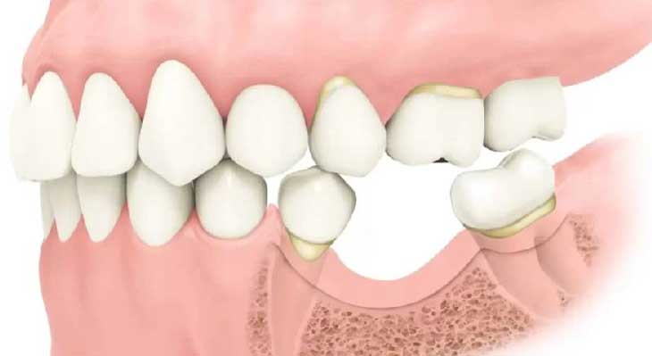 تحلیل استخوان فک