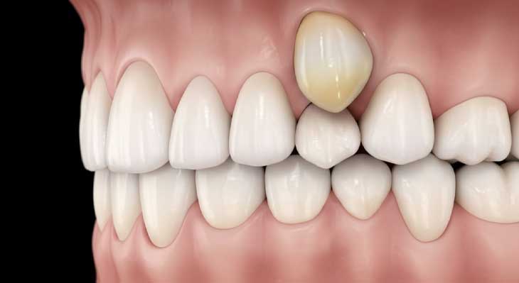 در آمدن دندان بالای لثه