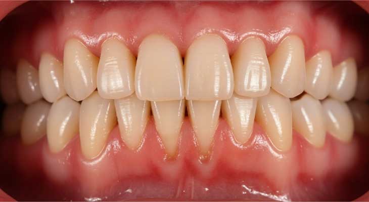 عقب رفتن لثه