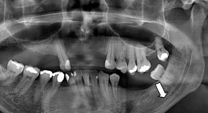 تحلیل استخوان فک
