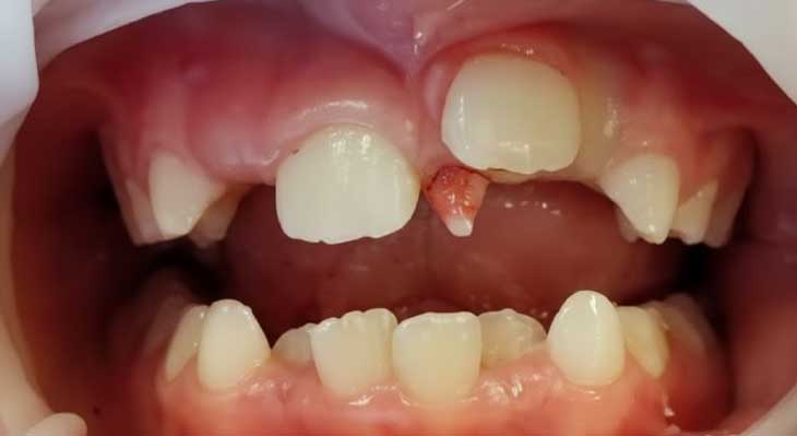 در آمدن دندان بالای لثه