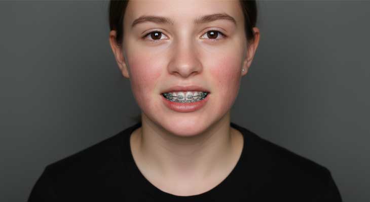 واکنش آلرژیک به براکت های ارتودنسی