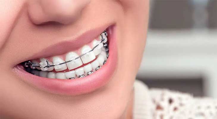ارتودنسی فلزی یا سرامیکی؟