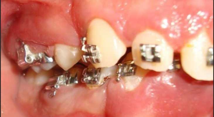 عوارض ارتودنسی دندان