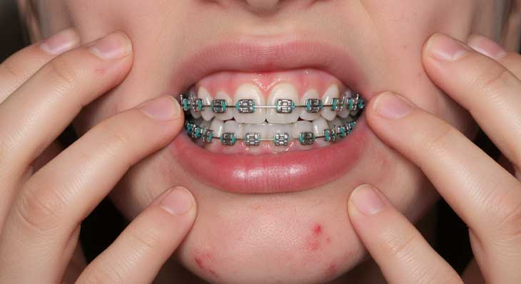 واکنش آلرژیک به براکت های ارتودنسی