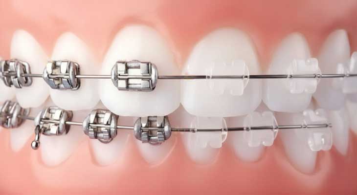 ارتودنسی فلزی یا سرامیکی؟