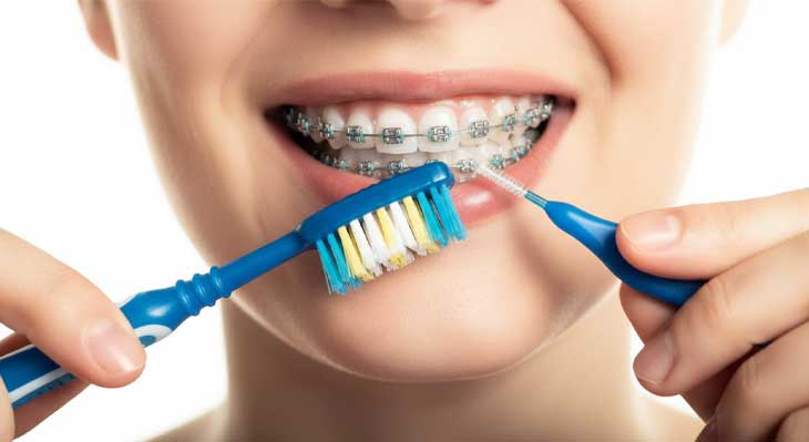 تمیز کردن براکت های ارتودنسی