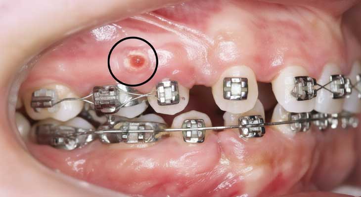 عوارض ارتودنسی دندان