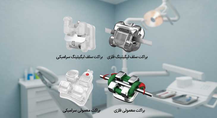 براکت سلف لیگیتینگ