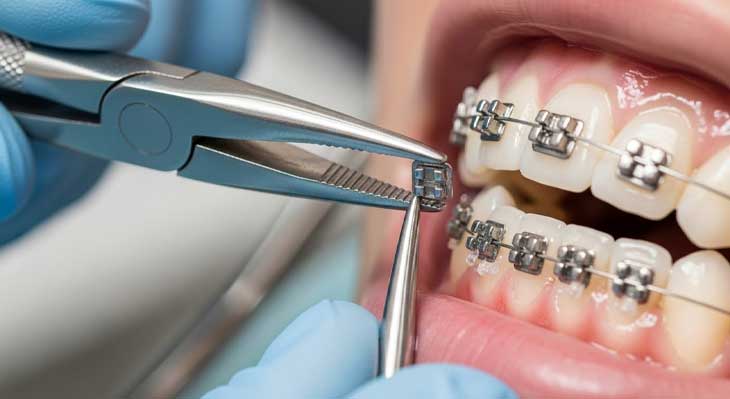 برداشتن براکت ارتودنسی