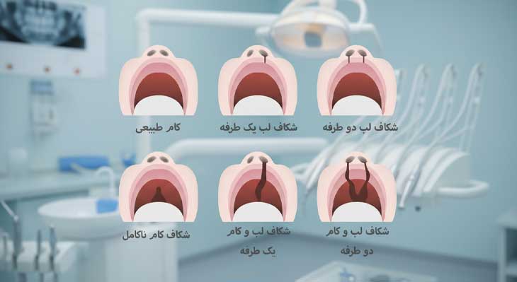 درمان شکاف کام و لب با ارتودنسی