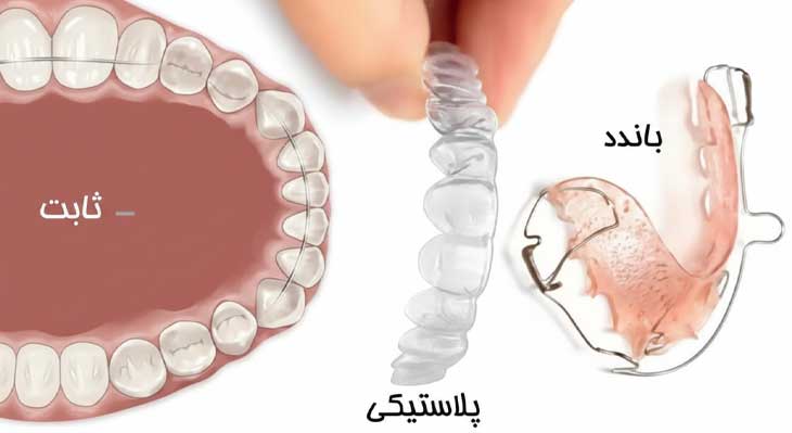 پلاک متحرک بعد از ارتودنسی