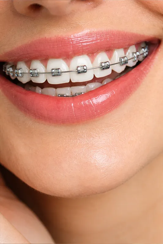 ارتودنسی ثابت در تهران